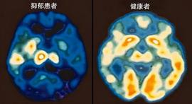 抑郁症做正规治疗和吃药是康复捷径，也要做心理治疗和自我成长_ION:CIA